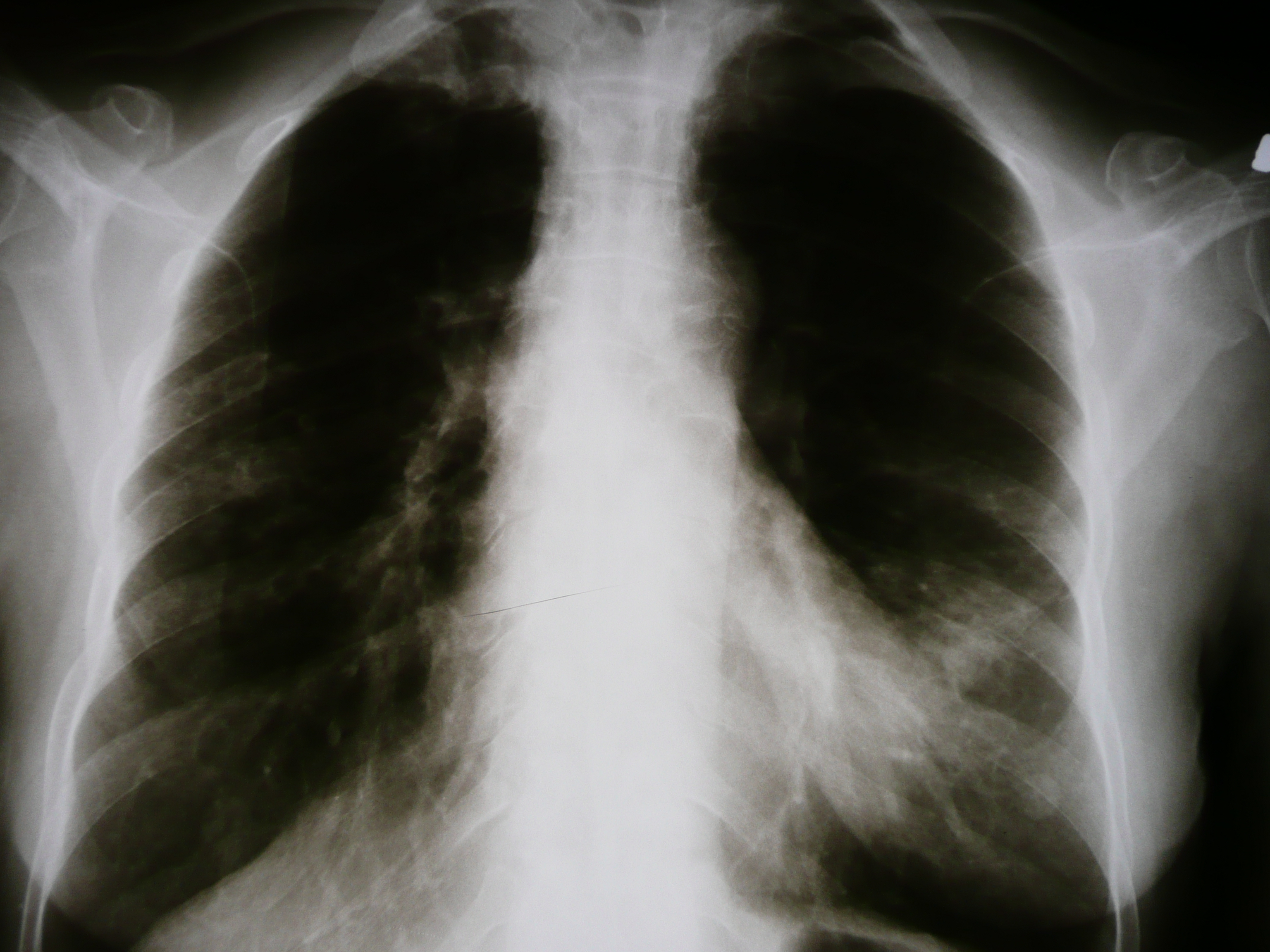 COVID-19 Chest X-Ray Classification with Deep Learning